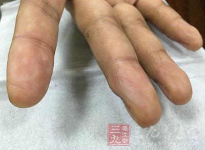 手上出現(xiàn)密密麻麻的小水泡